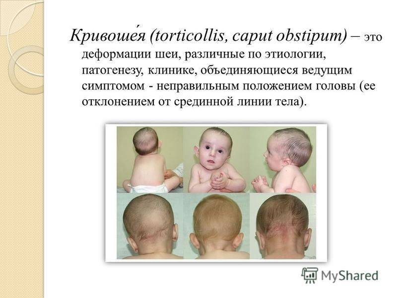 Операция при кривошее в москве, проведение операции при кривошее у детей в клинике цэлт.