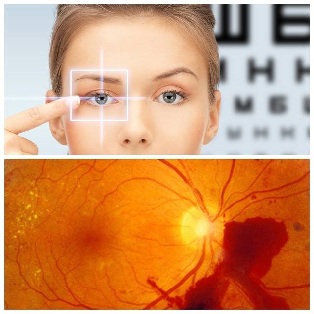 Из-за чего возникает фоновая ретинопатия и как она лечится?