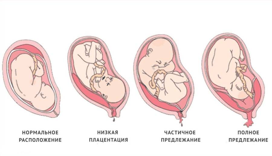 Низкое предлежание плода при беременности - чем опасно │ ребенок расположен низко в матке