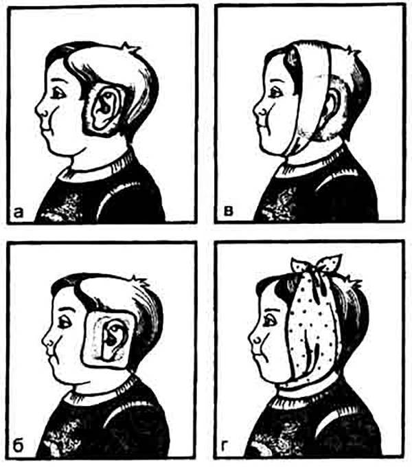 Алгоритм наложения согревающего компресса на ухо ребенку: постановка и техника спиртового компресса - как сделать правильно