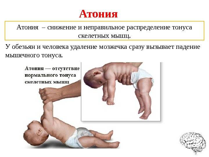 Чем опасен тонус матки при беременности и как убрать его в домашних условиях: рассказывает врач гинеколог