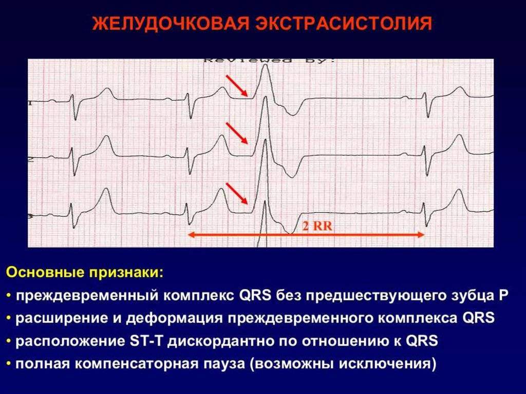 Нарушение ритма сердца, причины и лечение нарушения ритма сердца с диагностикой в центре