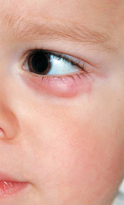 Ячмень на глазу у ребенка лечение – комаровский о причинах и лечении дома