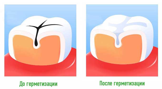 Гипоплазия зубов |