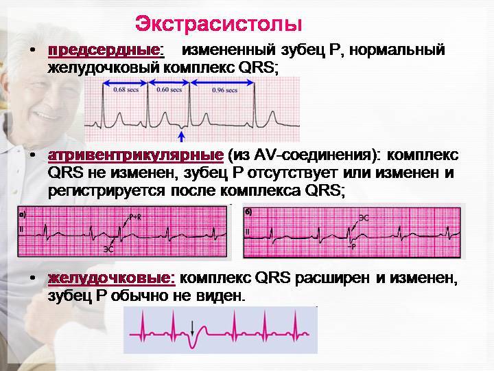 Наджелудочковые нарушения ритма сердца у взрослых
