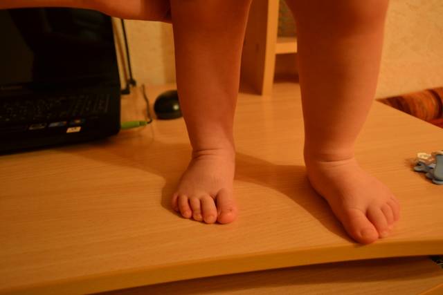 Что делать, если ребенок подвернул ногу и хромает?