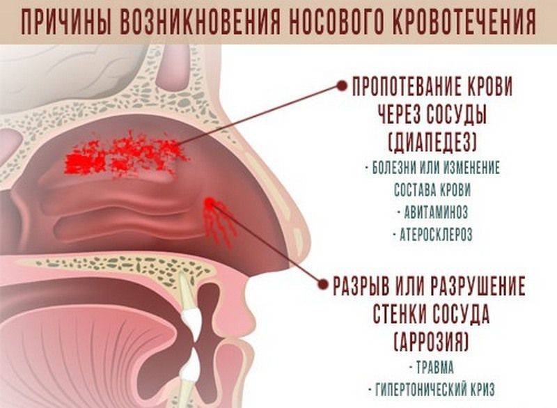 Комаровский – кровь из носа у ребенка: причины