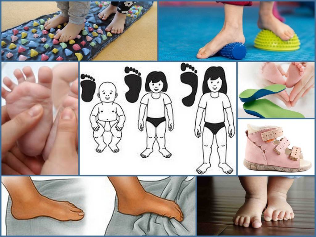 Халюс-вальгус - косточки на ногах: причины и лечение | медицинский дом odrex