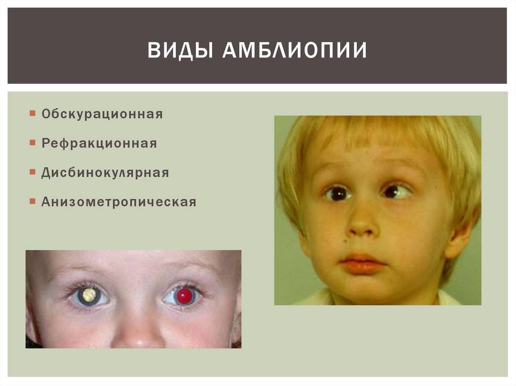 Как вылечить близорукость у ребенка? - энциклопедия ochkov.net