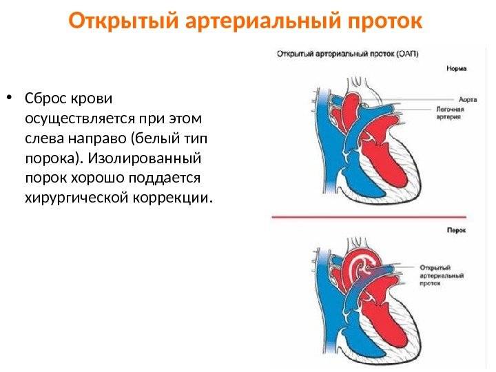 Открытый артериальный проток                (открытый боталлов проток)