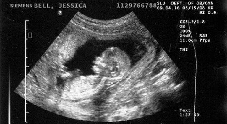 Узи плода 12 недель беременности. Беременность 12-13 недель фото плода на УЗИ. Снимки УЗИ на 13 неделе беременности. Снимок УЗИ 12-13 недель беременности фото. УЗИ 12 недель беременности.