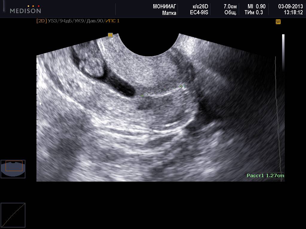 Размеры матки по узи при беременности: норма цервикометрии (шейки матки)