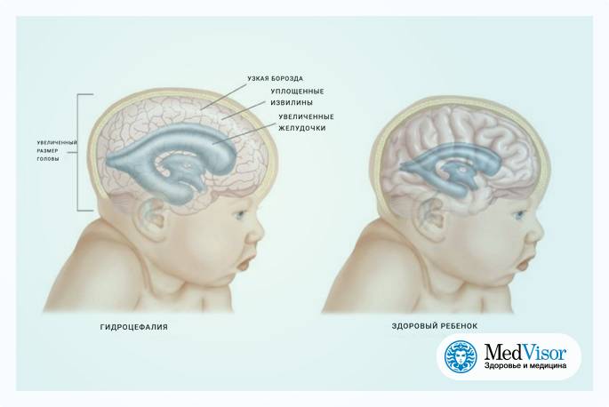 Признаки сотрясения мозга у ребенка от 1 года до 2, у младенцев и грудничков до 12 месяцев: симптомы, как определить и понять?