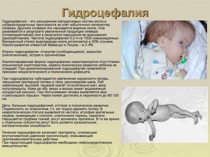 Врожденная гидроцефалия - симптомы болезни, профилактика и лечение врожденной гидроцефалии, причины заболевания и его диагностика на eurolab
