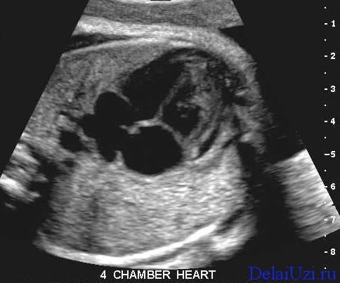 На каком сроке начинает биться сердце у эмбриона и как его услышать?