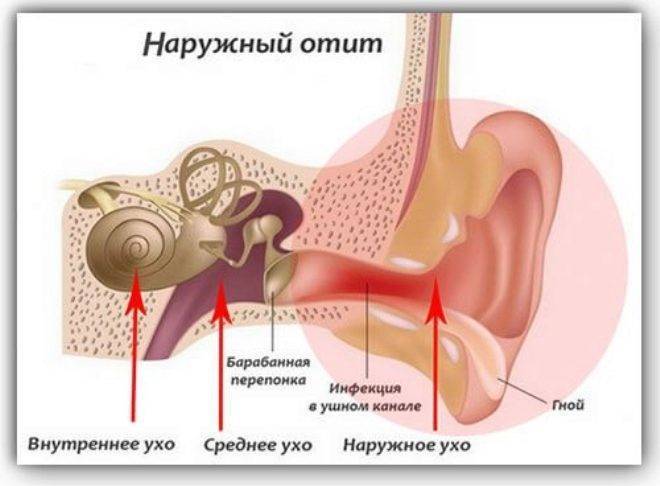 Отит среднего уха у детей (хронический) - симптомы болезни, профилактика и лечение отита среднего уха у детей (хронического), причины заболевания и его диагностика на eurolab