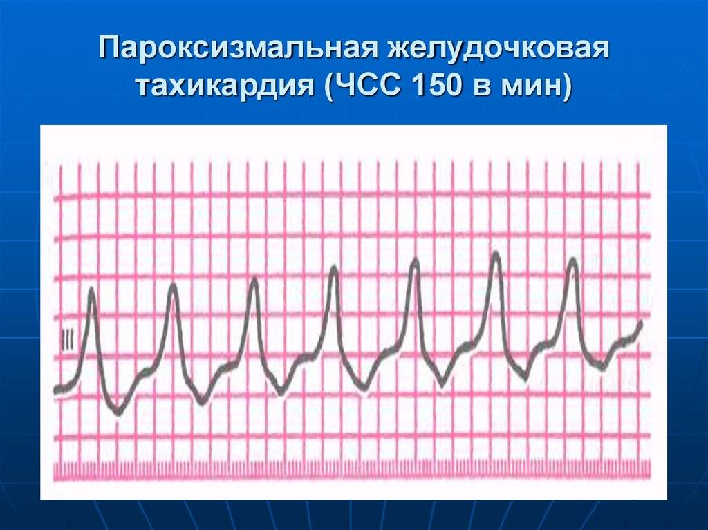 Тахикардия