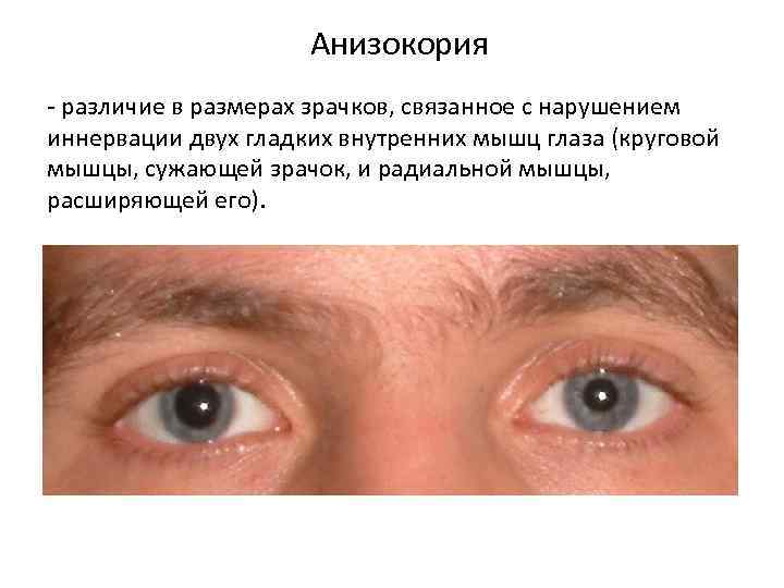 Расширенные зрачки у ребенка — причины всегда широких зрачков