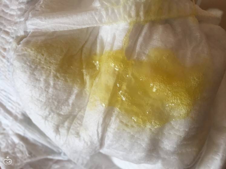 Желтые выделения из влагалища: причины и лечение * клиника диана в санкт-петербурге