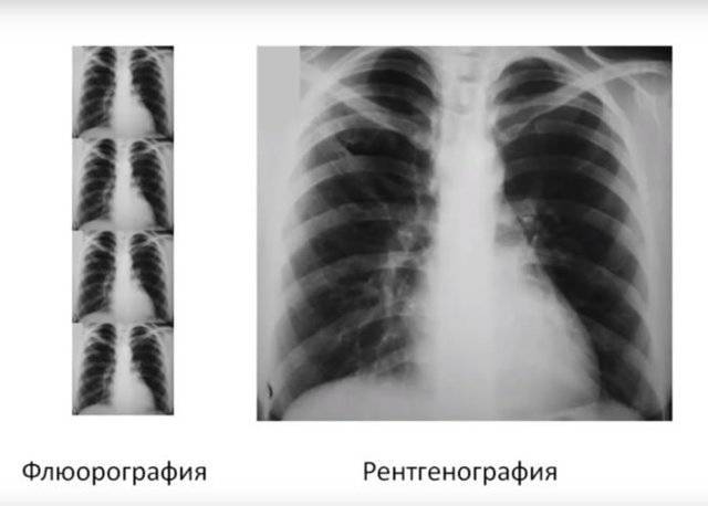 Рентген грудного отдела позвоночника, шейно грудного отдела позвоночника в москве, в клинике цэлт