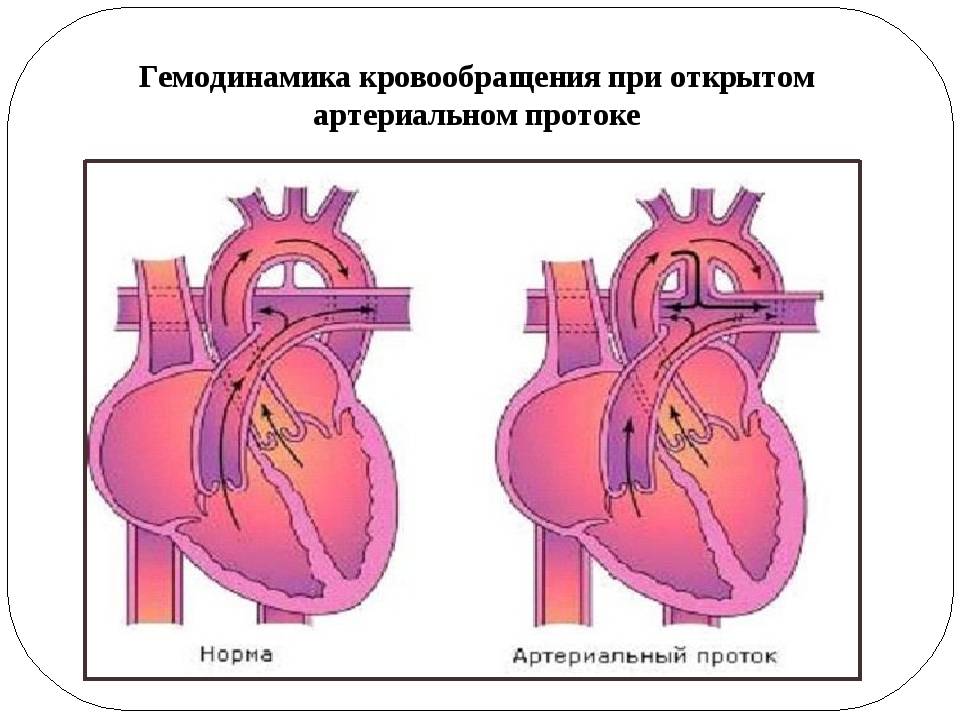 «немой» открытый артериальный проток - сибирский медицинский портал