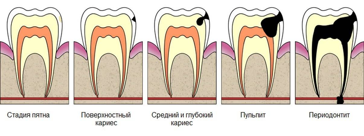 Лечение пульпита молочных зубов у детей