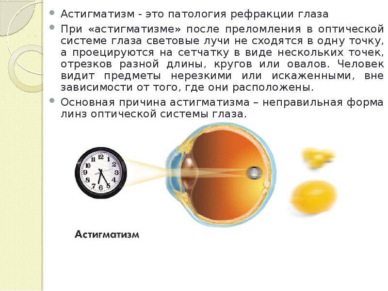 Гиперметропический астигматизм. Патология астигматизм. Дальнозоркий астигматизм у детей. Рефракционный астигматизм. Причиной астигматизма является:.