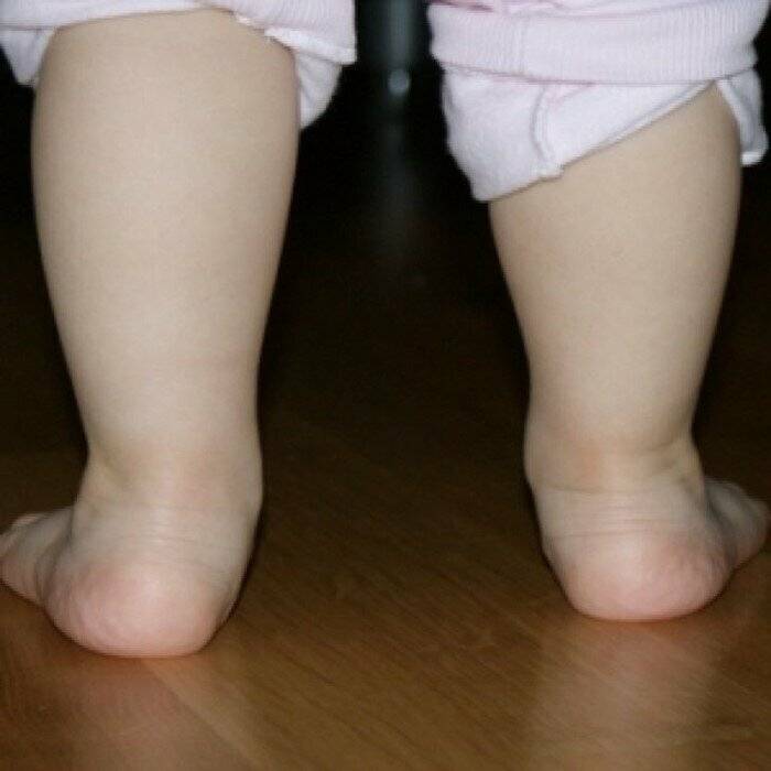 Косточка на ноге (вальгусная деформация)