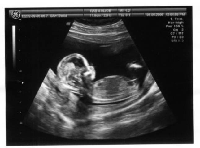 УЗИ на 14 неделе беременности: размер плода и другие особенности
