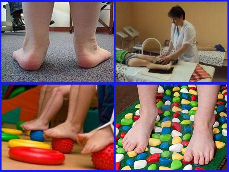 Плосковальгусная деформация или продольное плоскостопие у детей и взрослых; оперативное лечение плоскостопия; подтаранный артроэрез - arthroeresis | лечение косточек на ногах в киеве