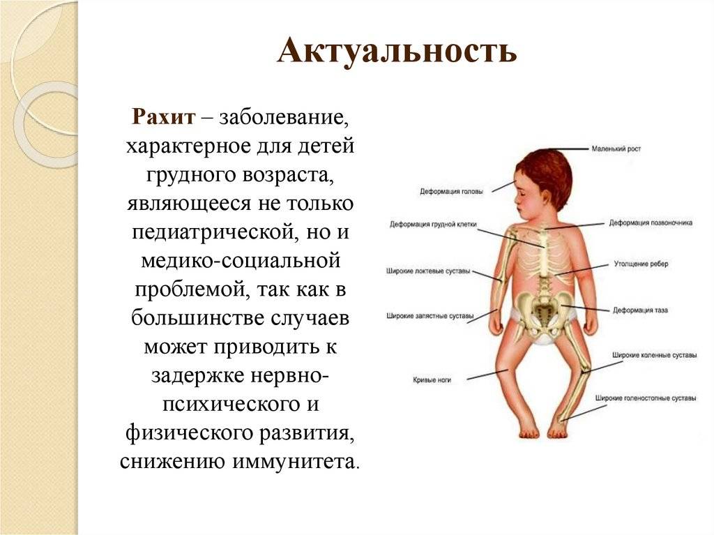 Рахит – признаки и симптомы, лечение, профилактика - сибирский медицинский портал