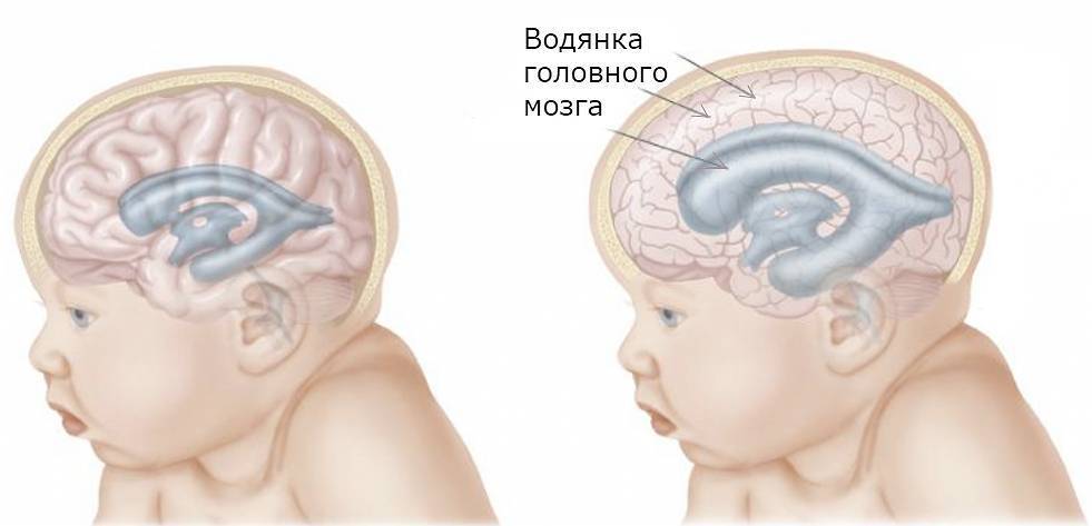 Сотрясение головного мозга у детей. признаки сотрясения мозга у ребенка до года