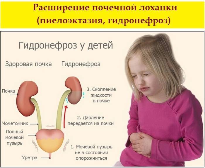 Гидронефроз у детей — лечение, диагностика, симптомы и причины болезни | николаев в.в.