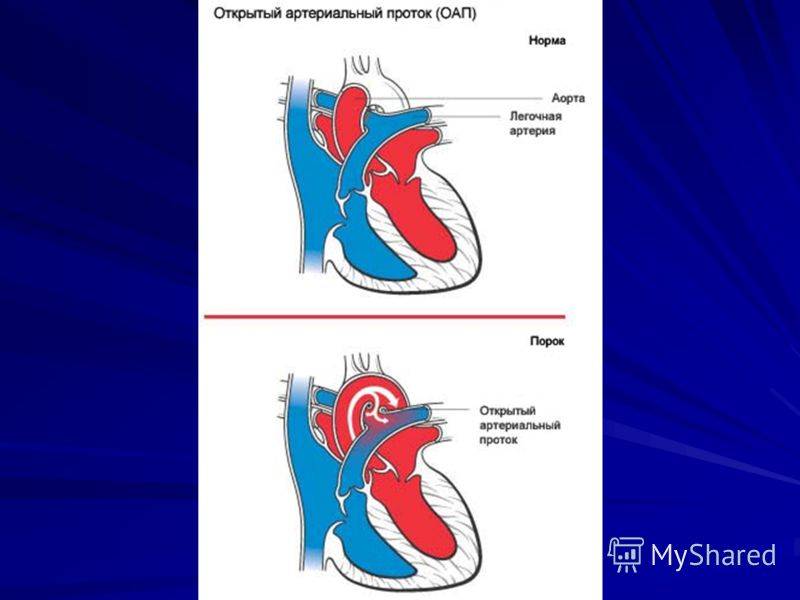 Оап у детей: лечение открытого артериального протока | клиника хадасса