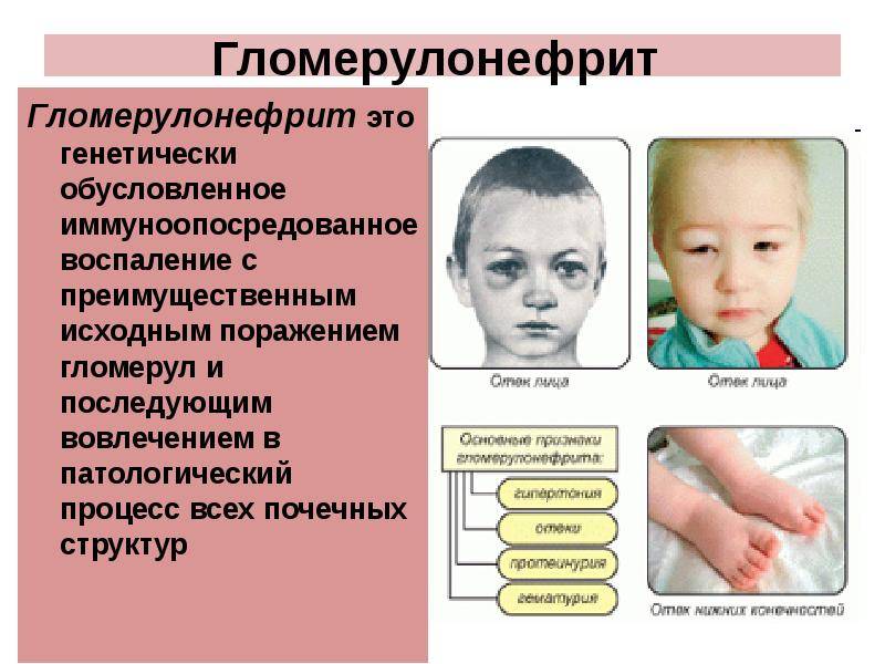 Заболевания почек у детей. симптомы и лечение заболевания почек у детей