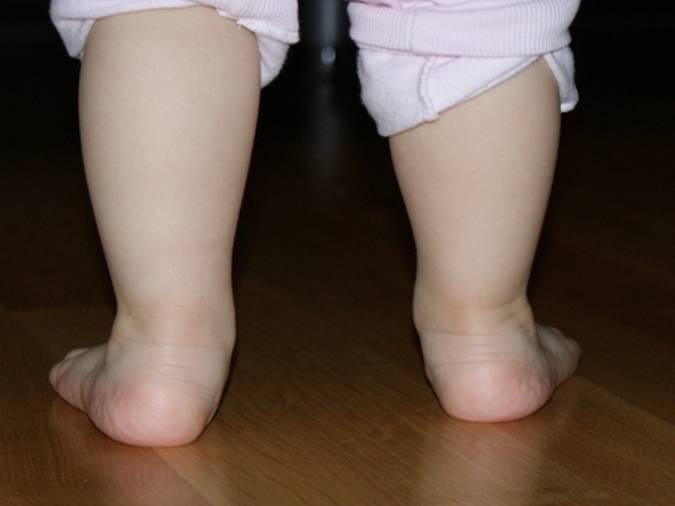 Варусная деформация стопы у детей (19 фото): лечение и виды, обувь