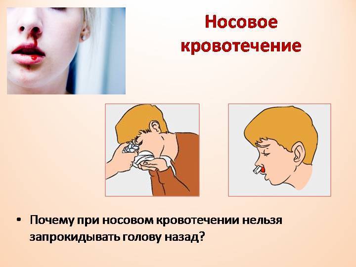 Как пользоваться гемостатической губкой для остановки крови из носа