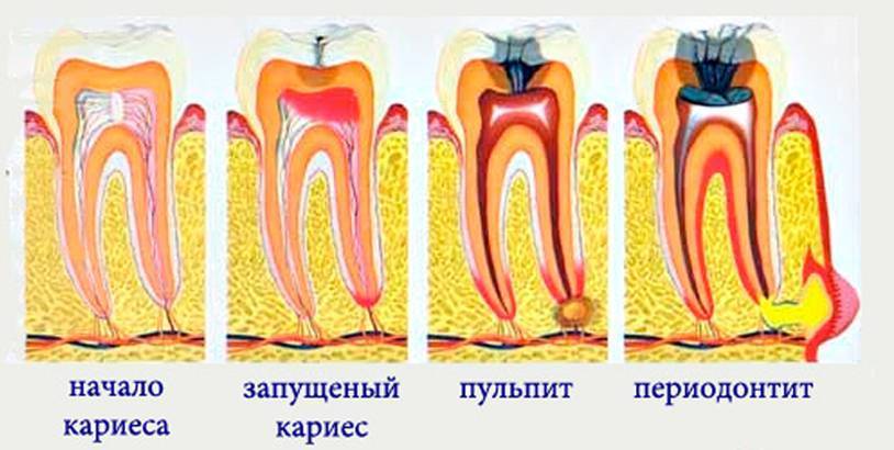 Пульпит молочных зубов: причины, симптомы и лечение