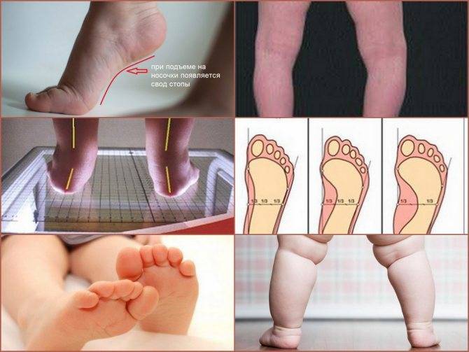 Варусная деформация стопы. причины и лечение варусной деформации стопы у детей