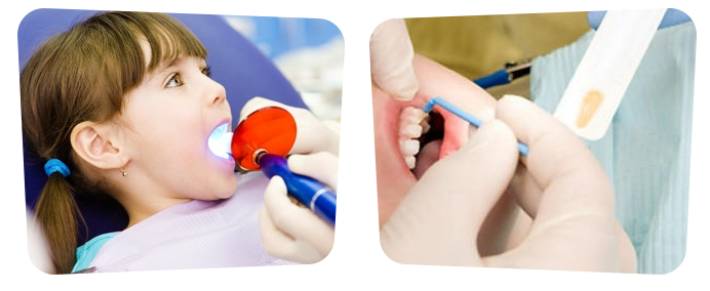 Фторирование зубов у детей и взрослых