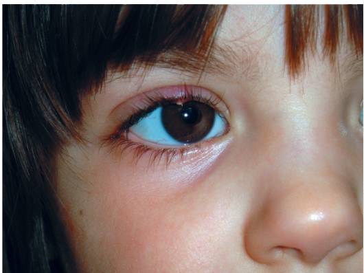 Как выглядит ячмень на глазу у ребенка — что делать, советы комаровского