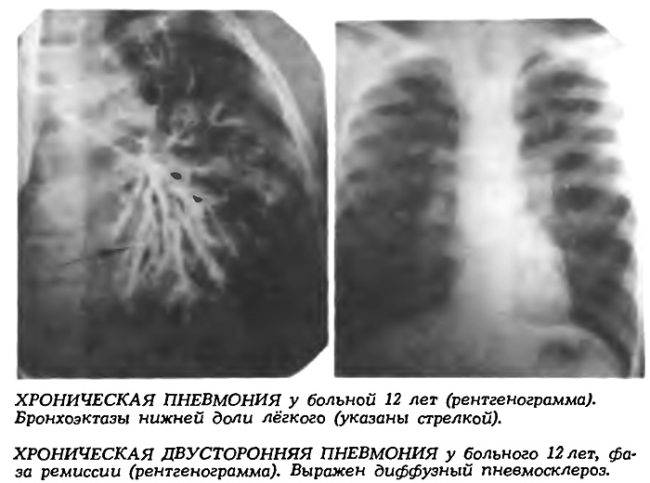 Пневмония легких опасно. Хроническая пневмония рентген. Обструктивная двусторонняя пневмония. Двухсторонняя пневмония рентген. Рентген легких пневмония двухсторонняя.
