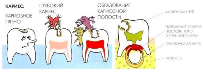 Бутылочный кариес у детей – фото, лечение молочных зубов до 3 лет и после