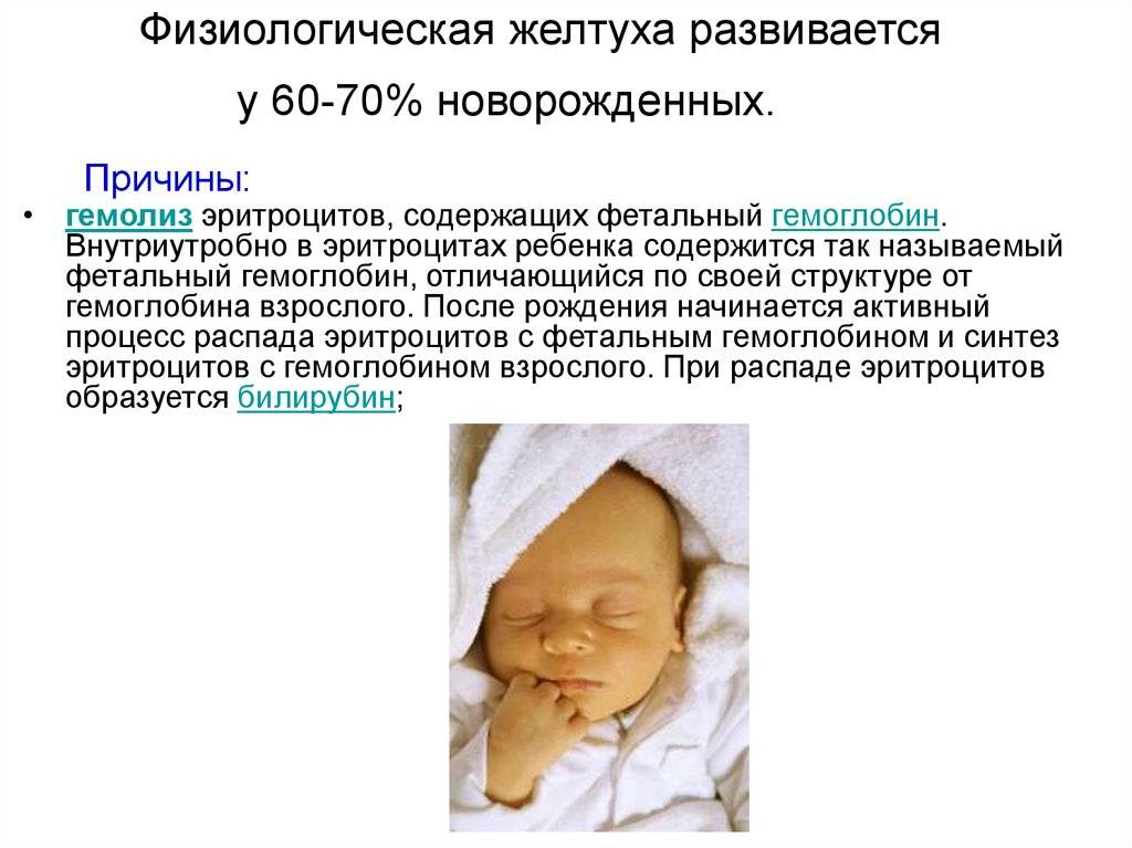 Желтуха у новорожденных: причины, симптомы, лечение