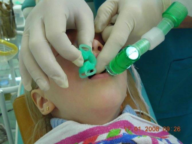 Лечение зубов под седацией (во сне) у детей в москве
