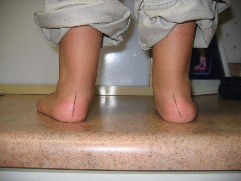 Ортопедические стельки при вальгусной деформации стопы