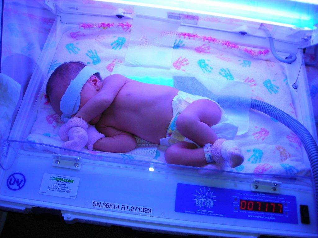 Физиологическая желтуха новорожденных - роддом "лелека"