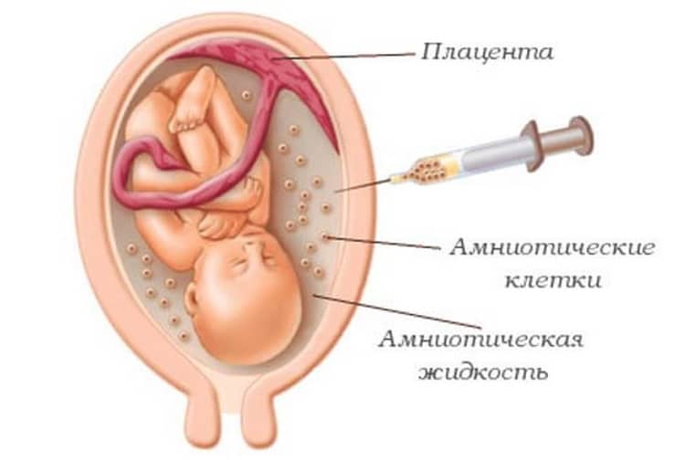 Амниоцентез при беременности: сроки и показания к процедуре | «юнона»
