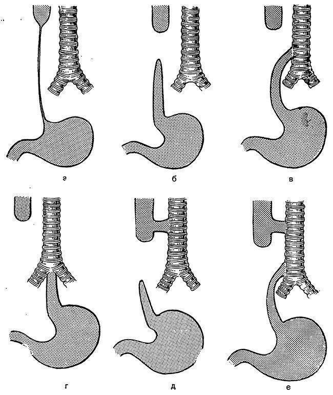 Атрезия это. Безсвищевая форма атрезии пищевода. Атрезия пищевода классификация. Атрезия и стеноз пищевода.