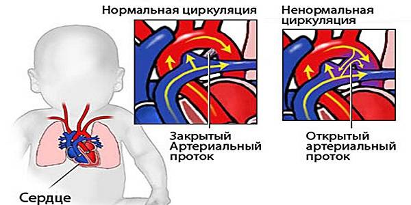 Врожденные пороки сердца (открытый артериальный проток, тетрада фалло, коарктация аорты, дефект межжелудочковой перегородки)